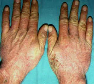 Como sanar la psoriasis los métodos públicos